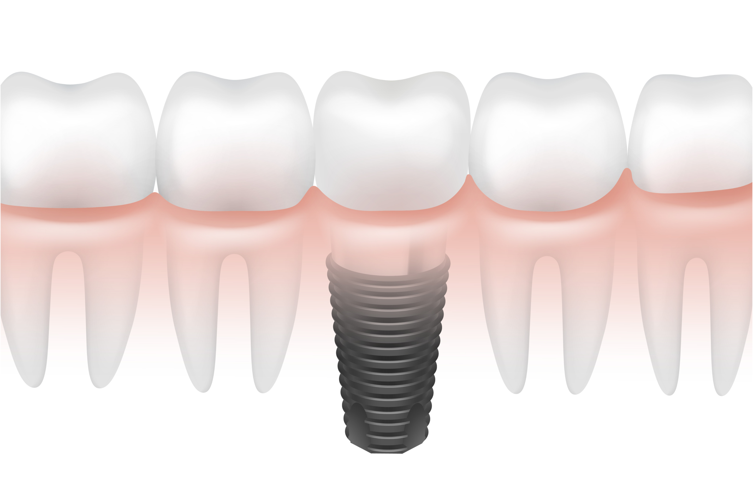 Dental Implant