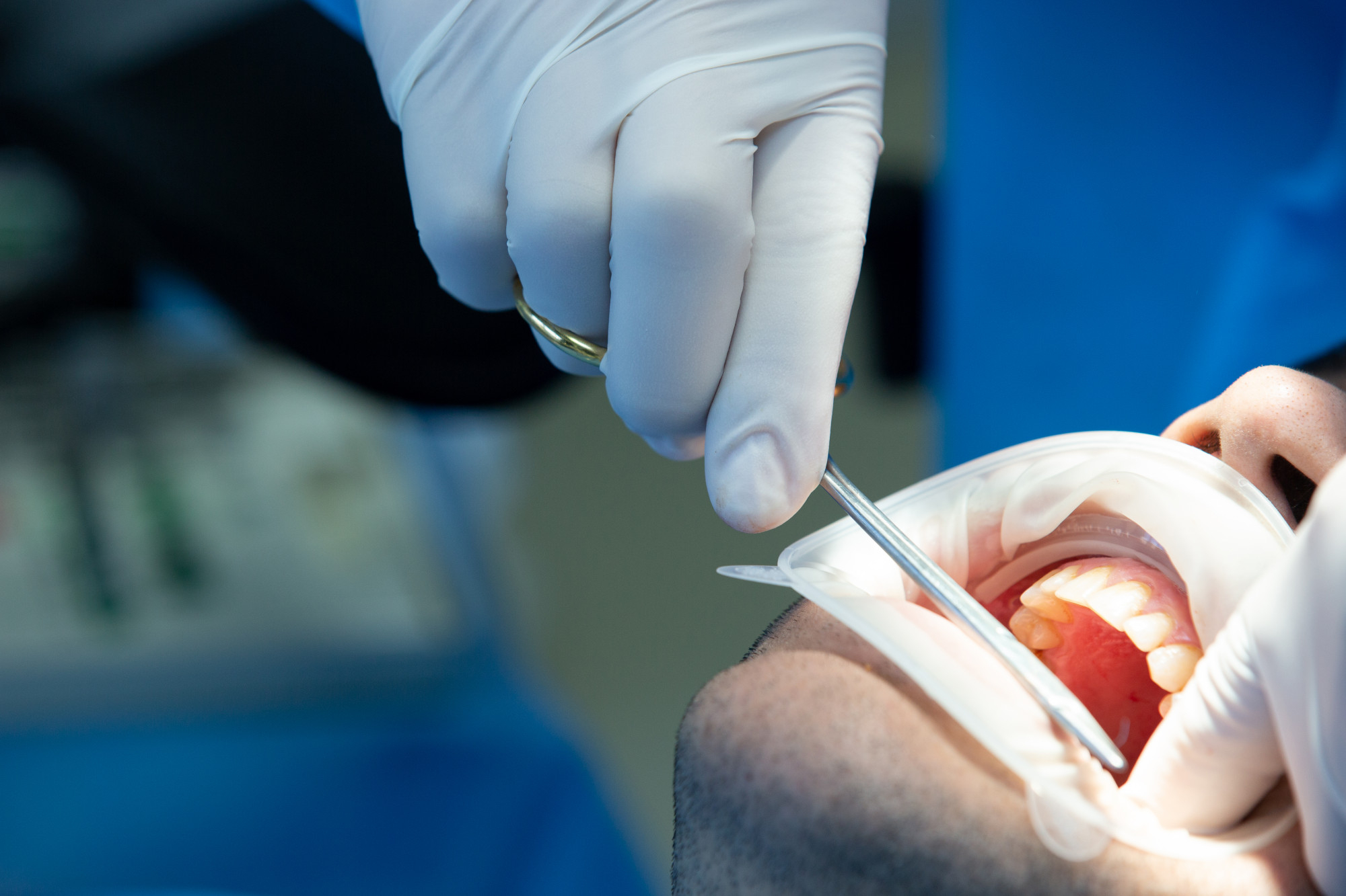 zahnarzt-mit-werkzeug-nimmt-einige-manipulationen-im-mund-des-patienten-vor